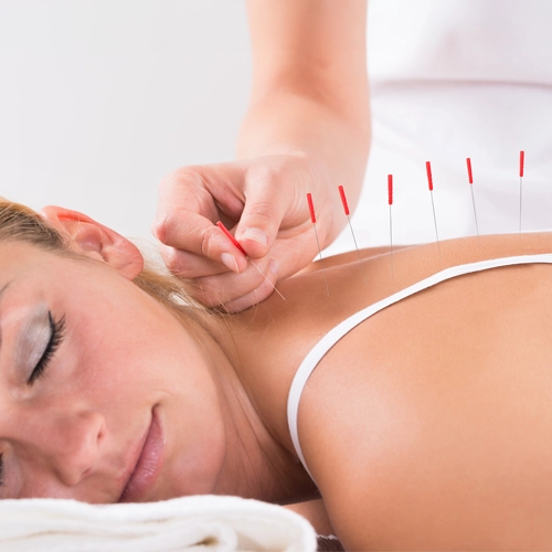 Chiropractic Westchase FL Woman Receiving Acupuncture